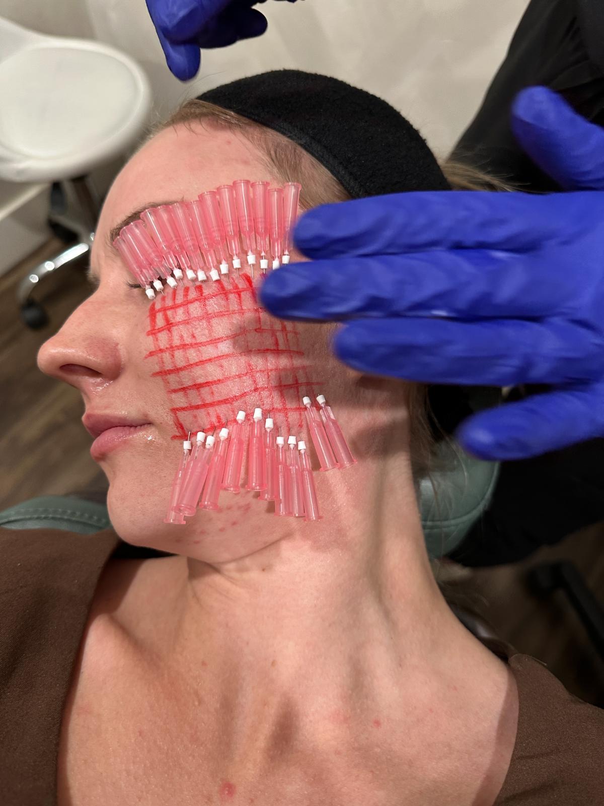 threading procedure for mild-moderate acne scarring