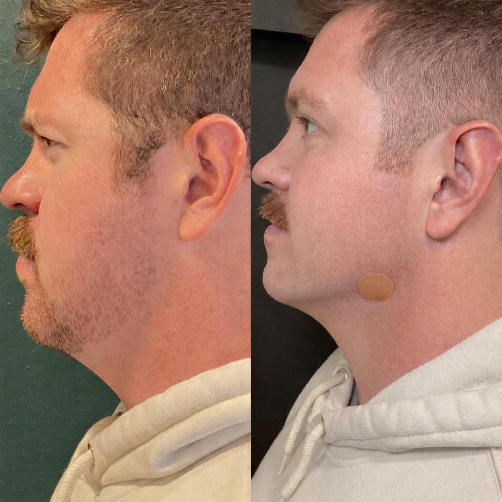 side profile of client who received a non-surgical facelift in Boise