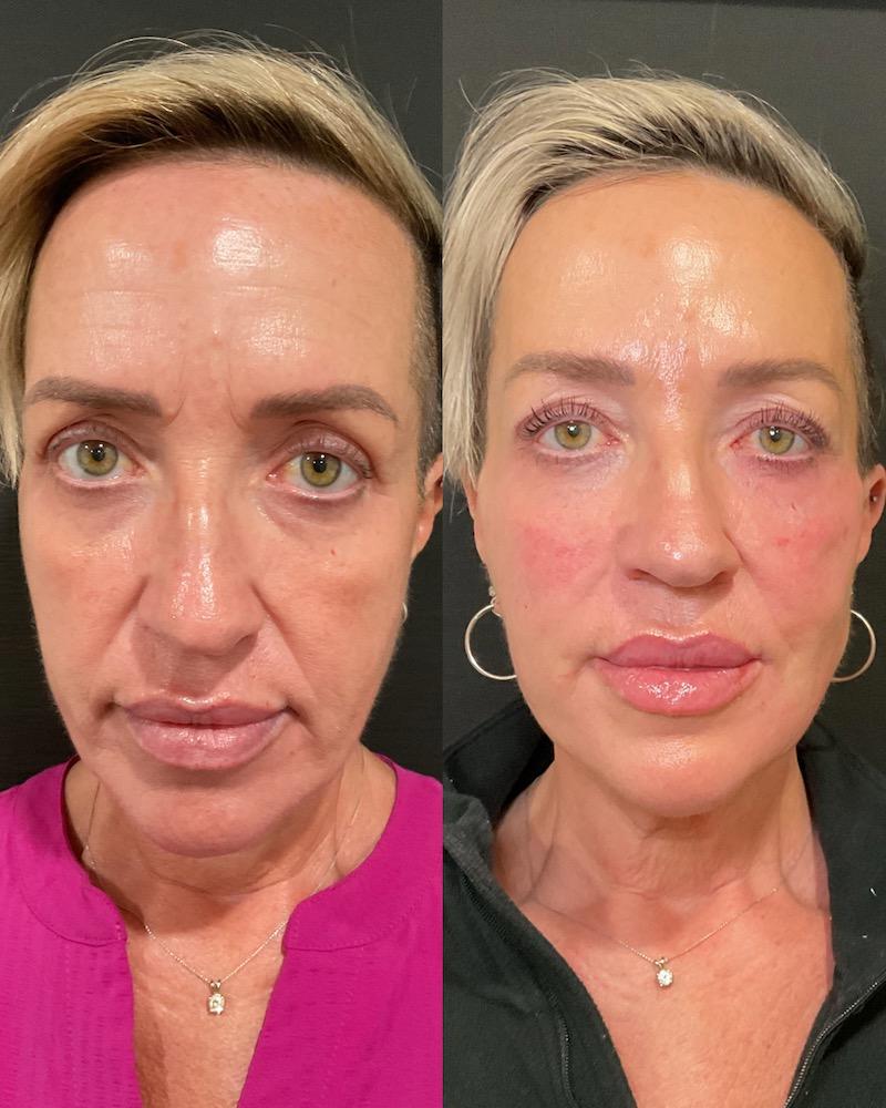 PDO threads in Boise, Boise medical spa