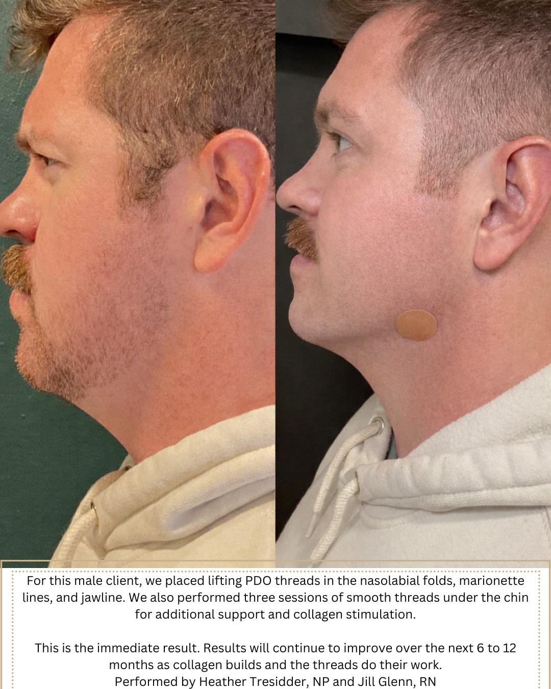 Performed by Heather, NP and Jill, Rn