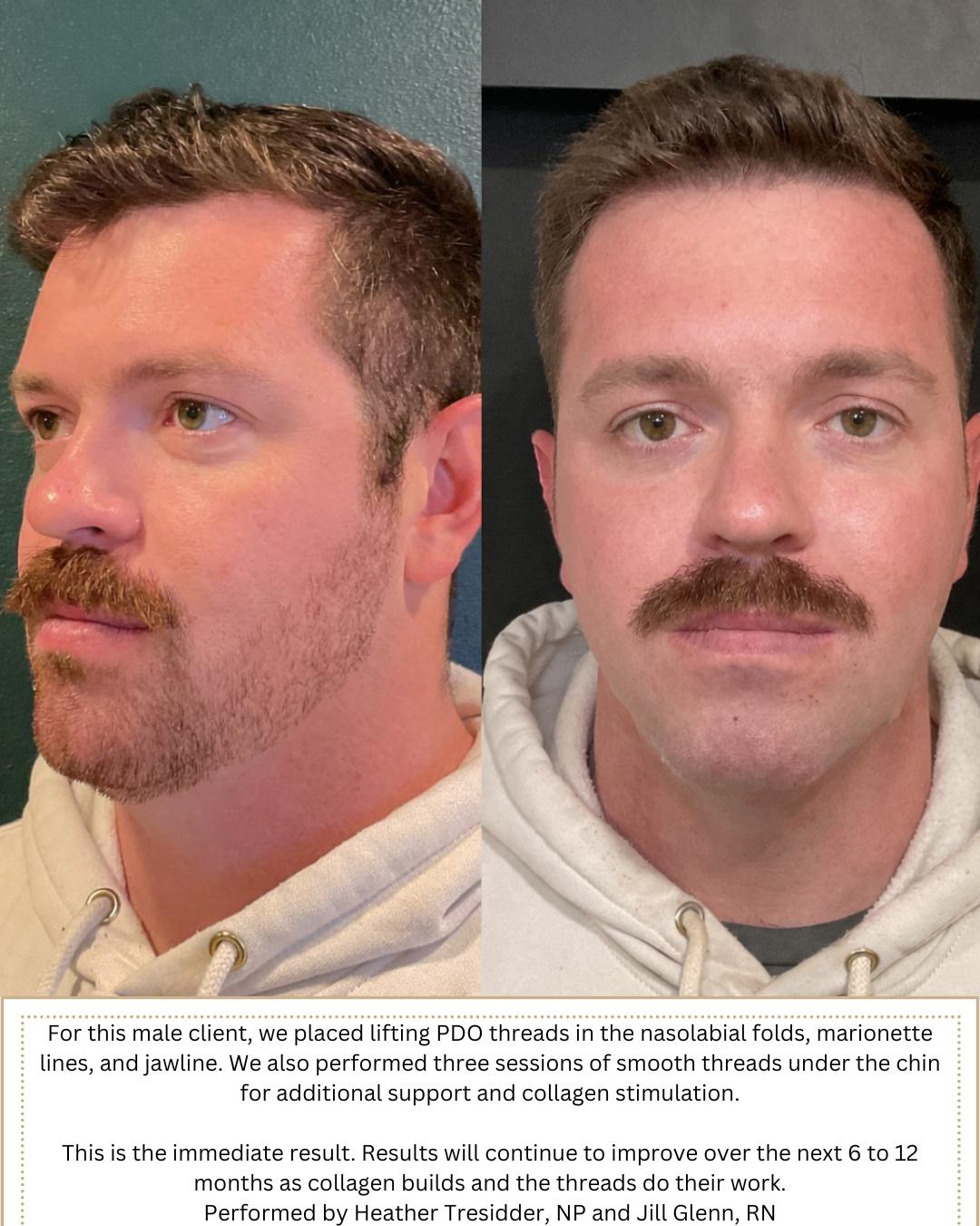 Performed by Heather, NP and Jill, Rn