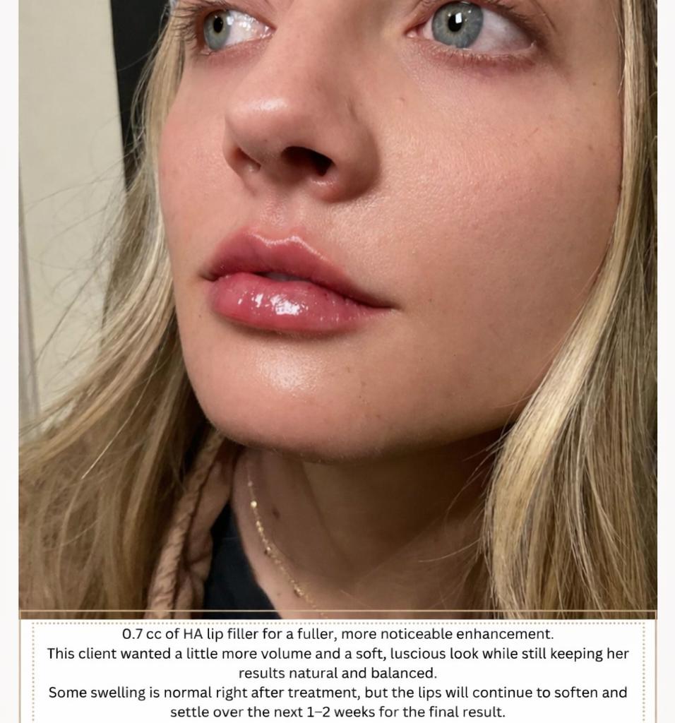 Performed by Heather, RN